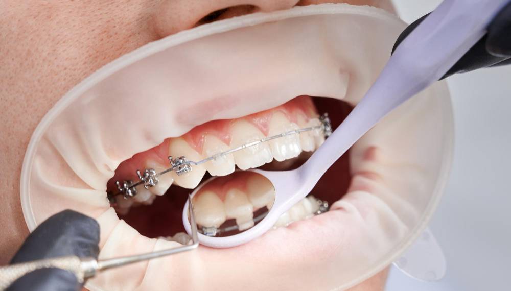 Dental Implant