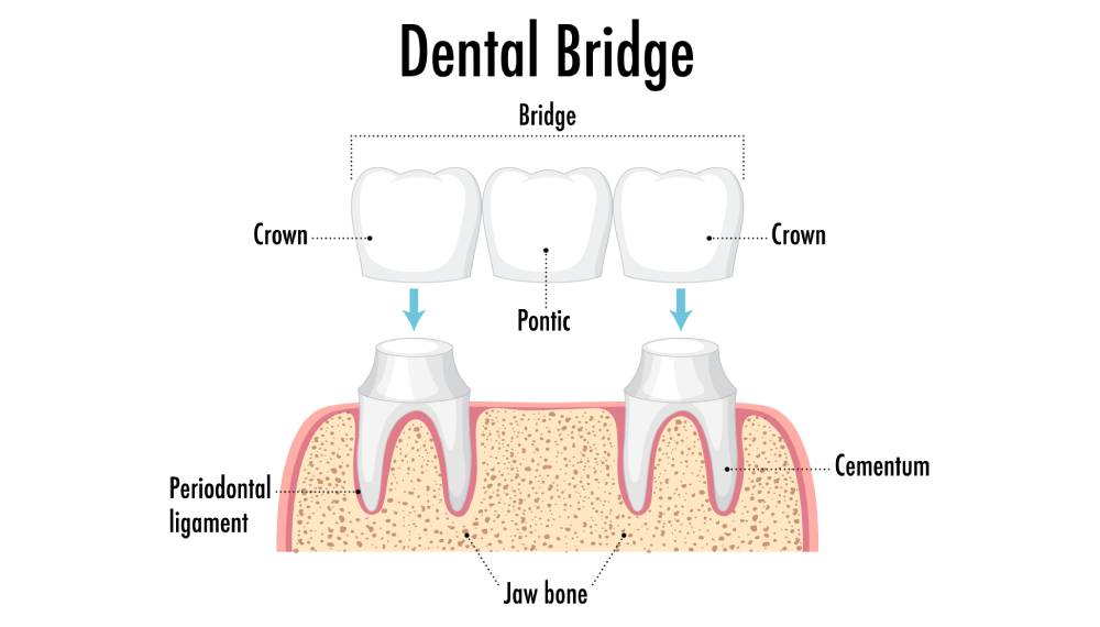 Dental Implant