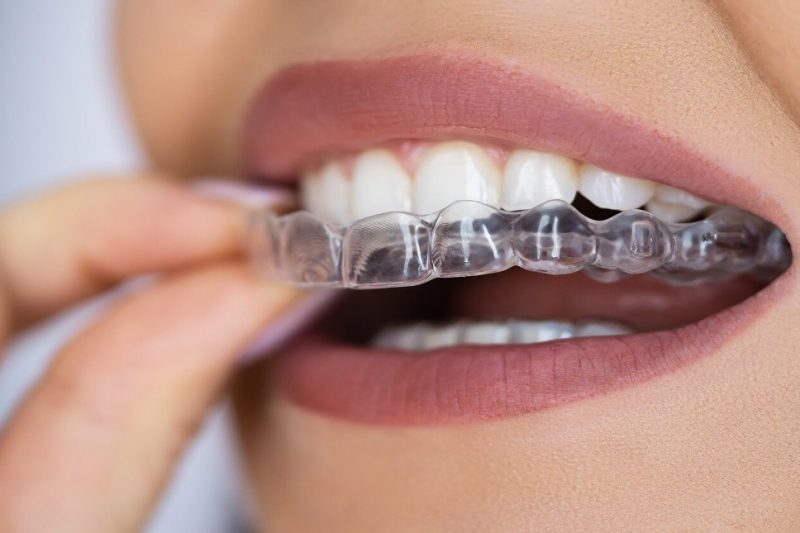 A Clear Path to a Straighter Smile: Understanding Clear Aligners (Invisalign Treatment)