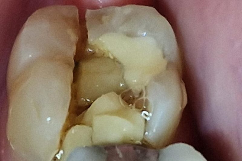 Fractured Teeth Fillings? Restore Your Smile at Oral Medics Dental Clinic