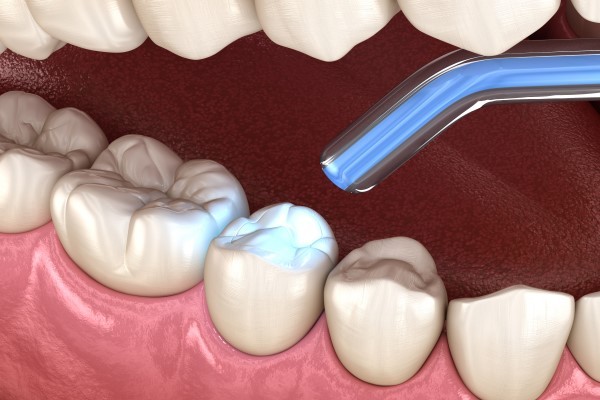 From Cavities to Confidence: Power of Dental Restorations