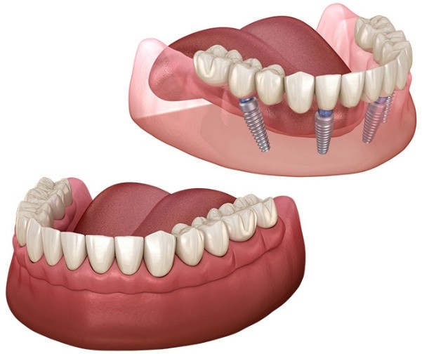 What Is a Full Mouth Dental Implant? A Complete Guide for Patients