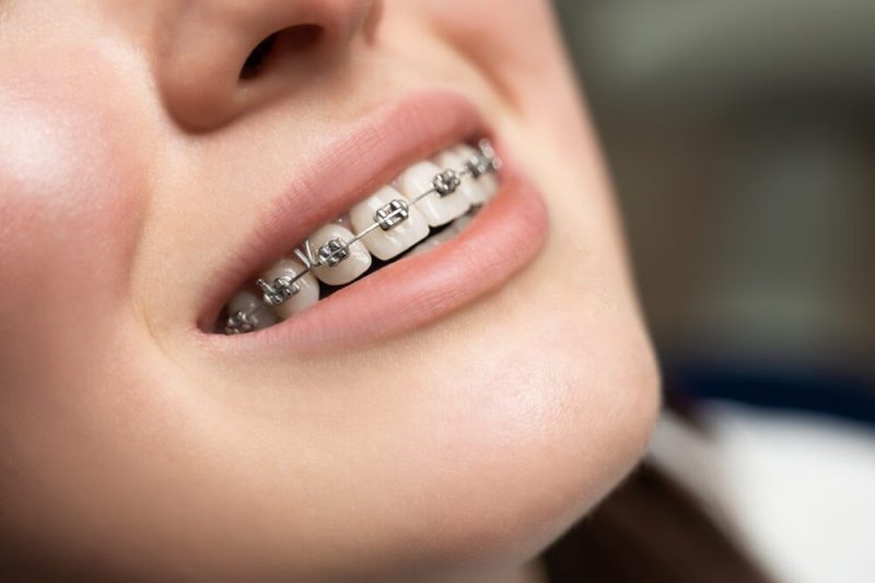 My orthodontic braces journey: bracket by bracket, wire by wire