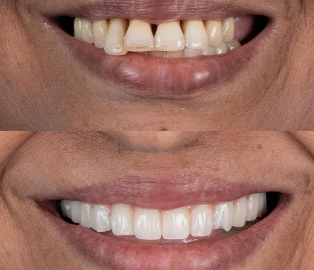 Full Mouth Rehabilitation: Everything You Need to Know About Rebuilding Your Smile
