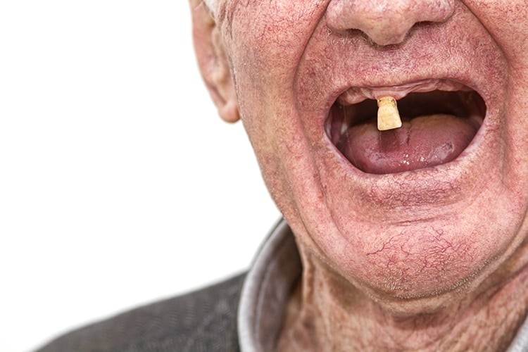Preventing Tooth Loss in Seniors: What Really Works