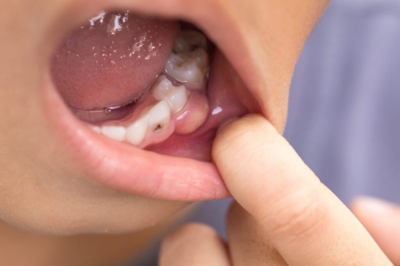 Suffering from a Swollen Jaw or Gum? It Could Be a Dental Abscess