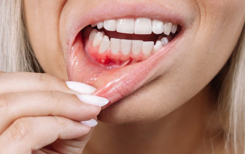 Gum Disease: A Silent Threat to Your Smile