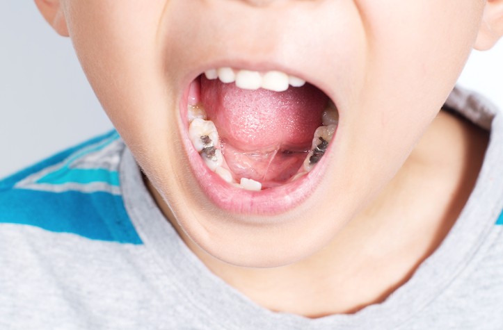 Does Your Child Complain About Toothache While Eating? It May Need a Filling