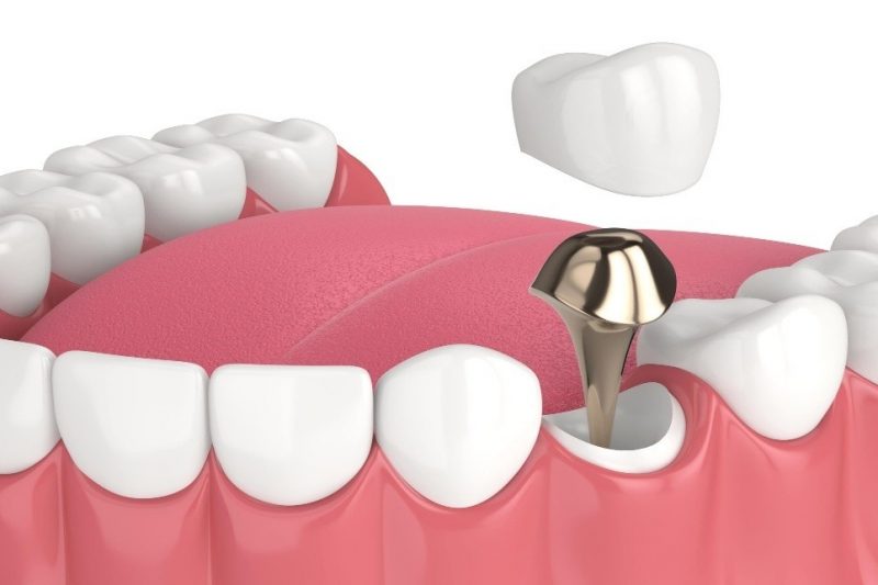 “Post and Core Explained: Rebuilding Your Tooth the Right Way”
