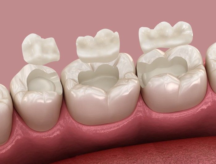 Inlays and Onlays: A Stronger Way to Fix Damaged Teeth