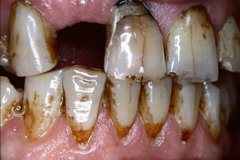 How Smoking and Tobacco Affect Your Oral Health