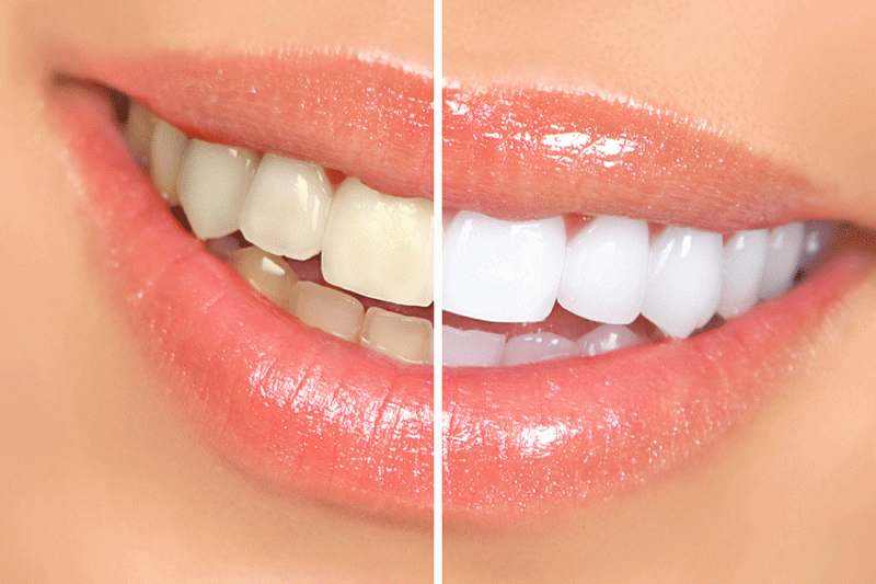 Teeth Whitening: Myths vs Facts – The Complete Guide for Patients