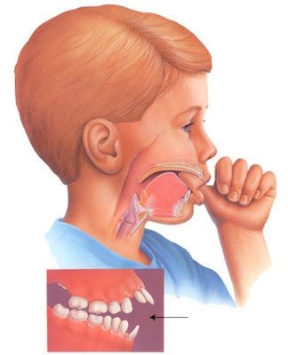 Thumb Sucking and Pacifier Use: When Is It a Problems