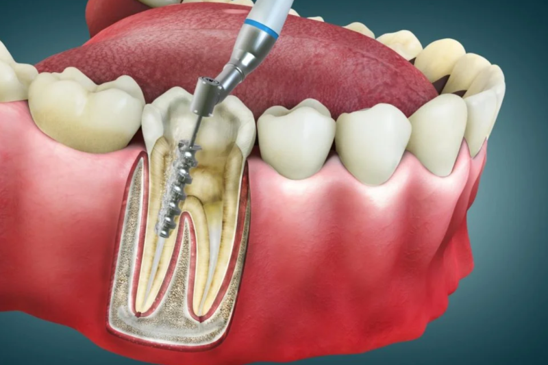 Root Canal Treatment: What to Expect and How It Saves Your Tooth
