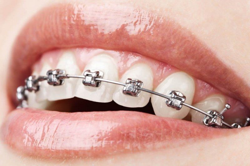Metallic Braces: Straighten Your Teeth with Confidence.
