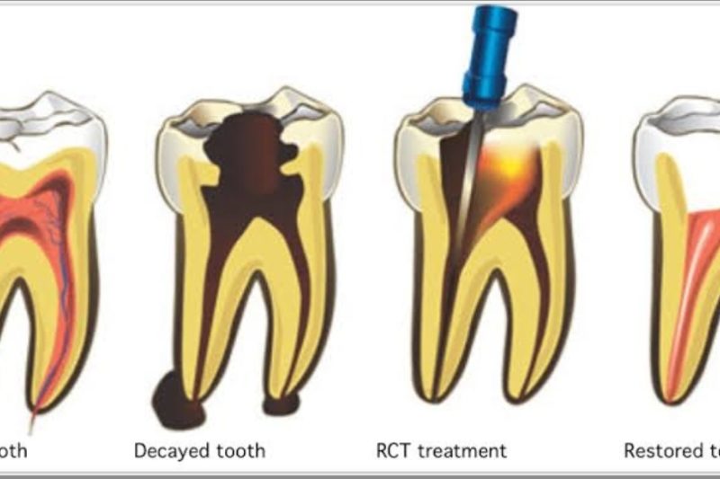 “Root Canal Therapy: Saving Your Natural Tooth with Confidence”
