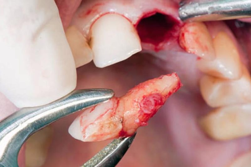 Understanding Tooth Extraction: Your Questions Answered