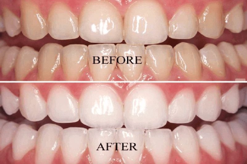 “How to Get a Radiant Smile: Expert Teeth Whitening Advice”